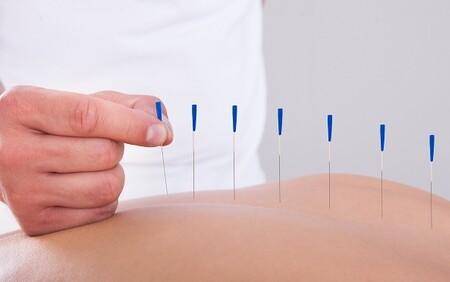 complimentary therapy acupuncture 